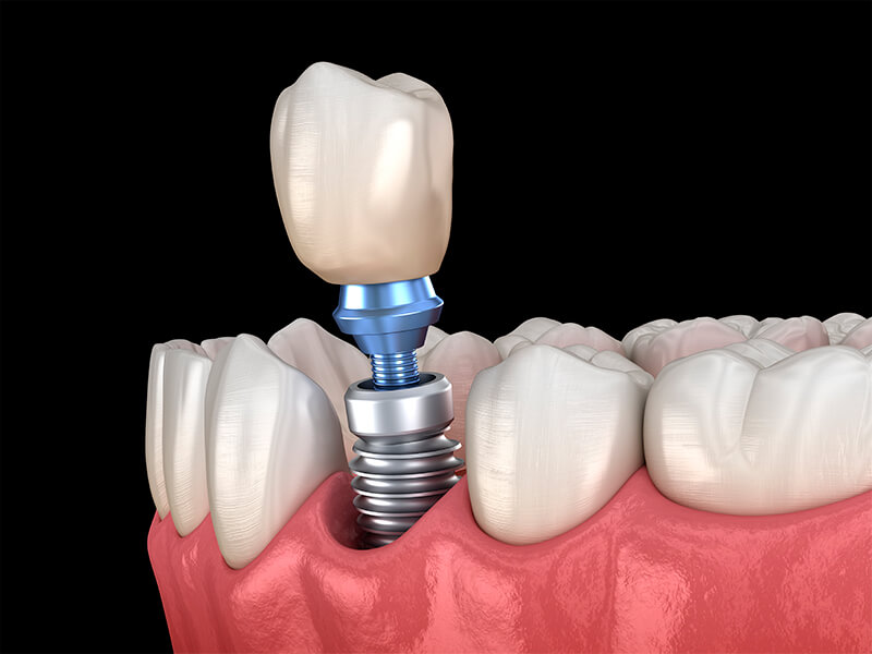 Implantes Dentários: A Solução Definitiva para a Perda de Dentes