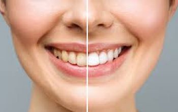 Clareamento Dental: Transforme Seu Sorriso em Poucas Sessões