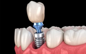 Implantes Dentários: A Solução Definitiva para a Perda de Dentes